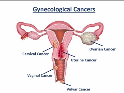 GYNECOLOGIC CANCER CARE