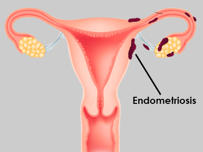 endometriosis