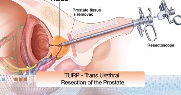 tuna prostate